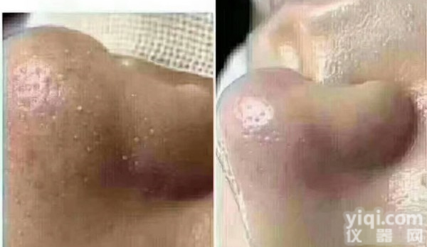 <em>韩国</em>小气泡导入头<em>超音波</em>