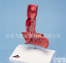 人体解剖<em>模型</em>-食管<em>疾病</em><em>模型</em> 飞斯富睿 F10919