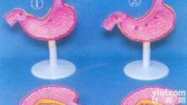 GD-0326A4  大型<em>病态</em>胃解剖放大<em>模型</em>