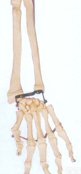 GD/A11125  手掌骨带<em>尺骨</em>和<em>桡骨</em>模型