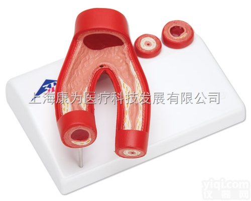 G40  <em>动脉硬化</em>模型，带动脉切面，2部分|德国3B人体解剖模型