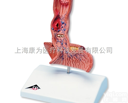 K-18  食管<em>疾病</em><em>模型</em>|德国3B人体解剖<em>模型</em>