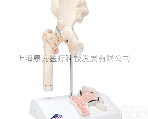 A88  大腿<em>骨折</em>和髋关节炎<em>模型</em>|德国3B人体解剖<em>模型</em>