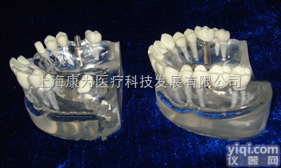 KDF/KQ003  单颗<em>种植</em>体与烤瓷桥体修复对比模型