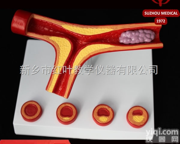 血栓<em>模型</em> <em>动脉硬化</em><em>模型</em> 医学教学<em>模型</em>