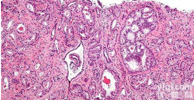 <em>ME12</em><em>前列腺癌</em>