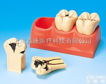 KAH/B10009  龋齿分<em>解剖</em>模型  牙<em>科教</em>学