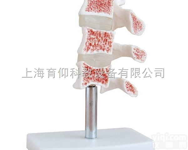 骨质疏松模型（<em>脊椎</em>典型病变模型）|人体<em>骨骼</em>模型