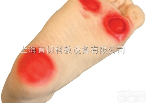 高级<em>糖尿病足</em><em>护理模型</em>|护理训练模型