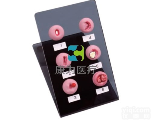 OG6170  <em>子宫</em><em>宫颈</em><em>病变</em>模型