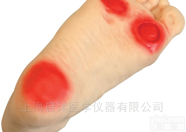 QS/HS19  高级<em>糖尿病足</em><em>护理模型</em>