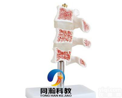 THM-134  <em>脊椎</em>典型病变模型|<em>骨骼</em>