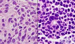 <em></em>C<em></em>a<em></em>l<em></em>u<em></em>-<em></em>6<em></em>�<em></em>�<em></em>�<em></em>�<em></em>�<em></em>�<em></em>�<em></em>�<em></em>�<em>人肺癌细胞</em><em></em>