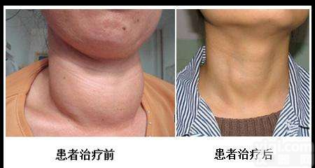 <em>甲状腺</em>乳腺<em>激光消融</em>