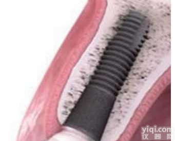 <em>种植</em>体系统 3FM14