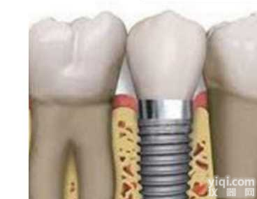 纯钛人工牙<em>种植</em>体及顶盖螺钉