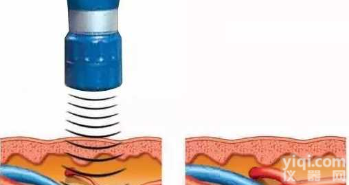 <em>冲击波</em><em>疼痛</em>ZL仪作用原理及ZL机制