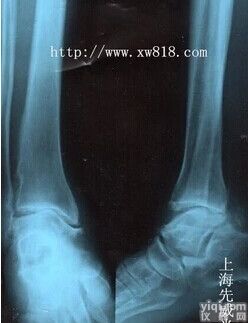 50<em>毫安</em><em>便携式</em>移动式x<em>光机</em>