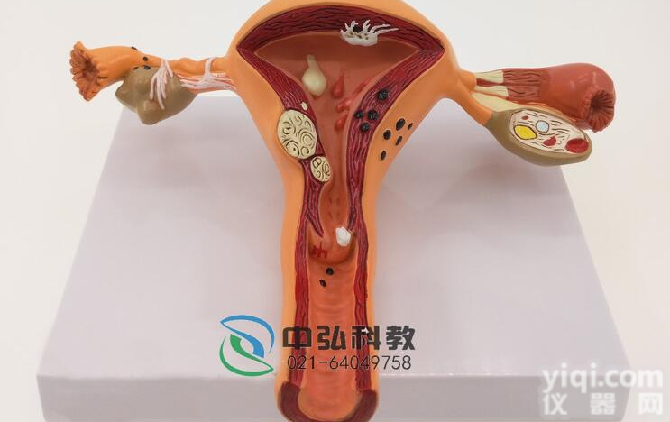 <em>子宫</em>病变<em>模型</em>，<em>子宫</em>疾病<em>模型</em>